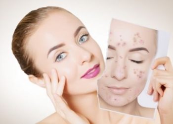 Why You Should Undergo Acne Treatment