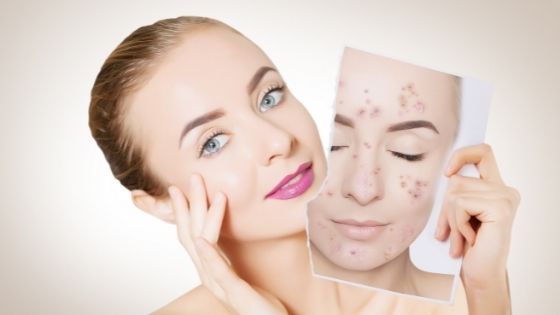 Why You Should Undergo Acne Treatment