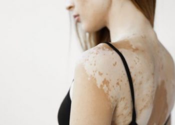 Home Remedies for Vitiligo