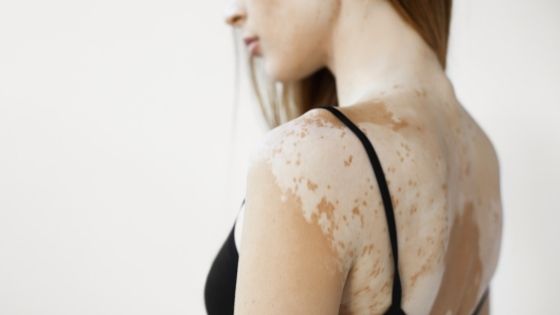 Home Remedies for Vitiligo